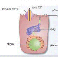 mucoviscidose